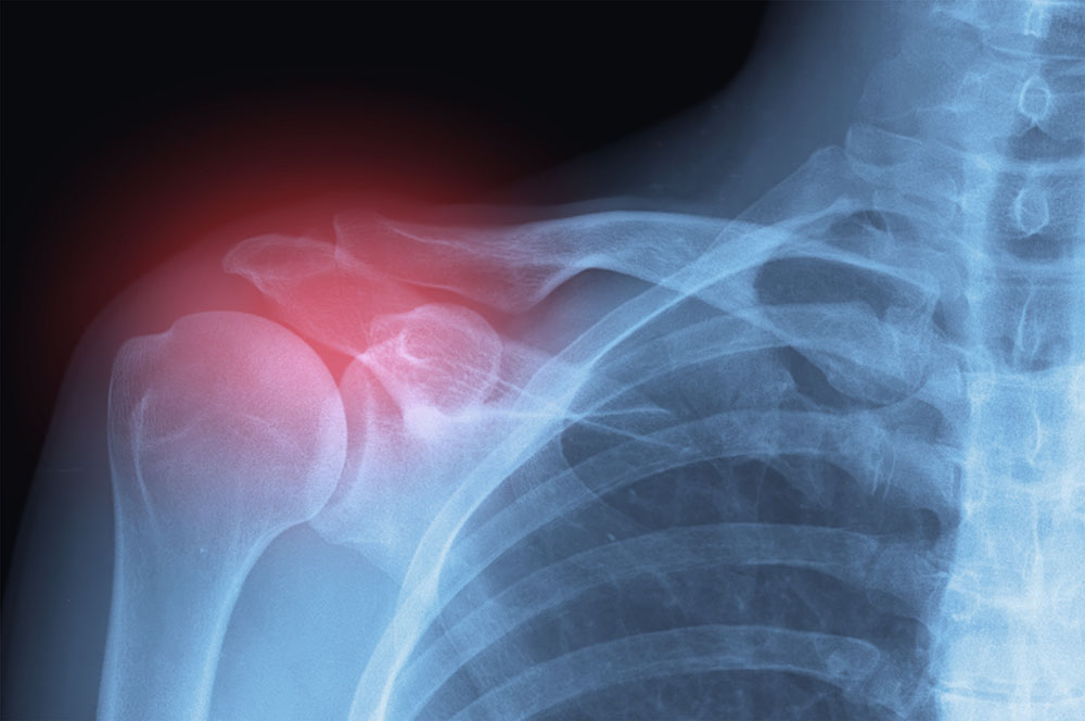 Röntgenaufname zeigt Schulter